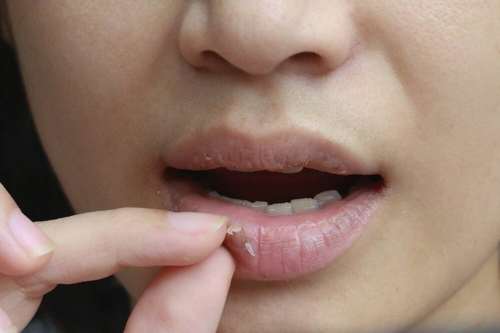 Dấu hiệu dị ứng kem đánh răng: môi khô, nứt nẻ, sưng môi Dấu hiệu dị ứng kem đánh răng: môi khô, nứt nẻ, sưng môi